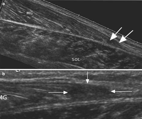 what test shows muscle tears|mri for muscle tear.